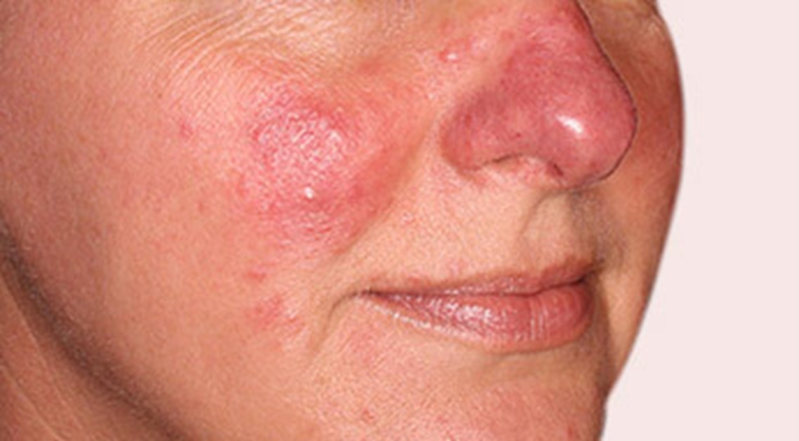 overschot Bijlage jury Rosacea - Huidaandoening in het gezicht | Velthuis kliniek