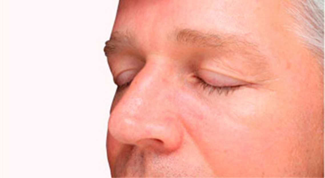 Rosacea Huidaandoening in het gezicht | Velthuis kliniek