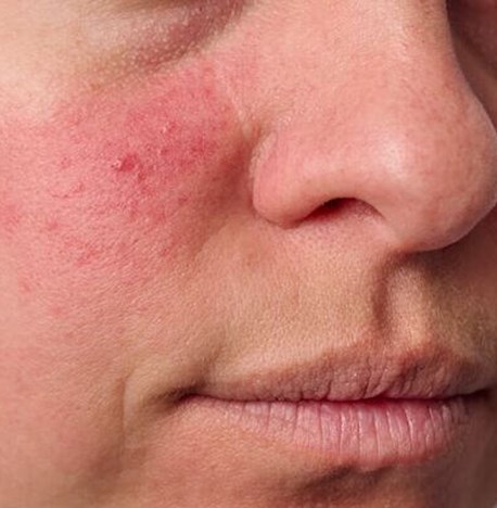 Speel inhoud Ontevreden Rosacea - Huidaandoening in het gezicht | Velthuis kliniek